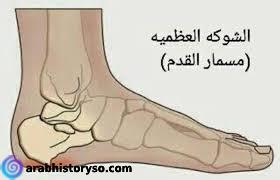 علاج مسمار القدم العظمي بالاعشاب